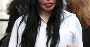 Pete Burns - Cirujía plástica