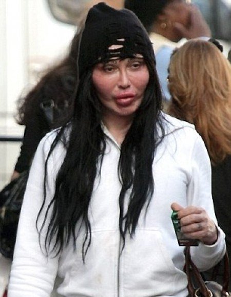 Pete Burns - Cirujía plástica
