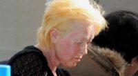 Cindy Lauper dermoabrasión