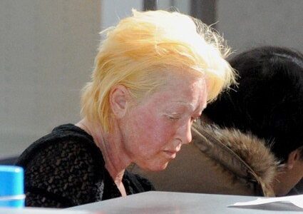 Cindy Lauper dermoabrasión