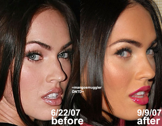 Rinoplastia de Megan Fox